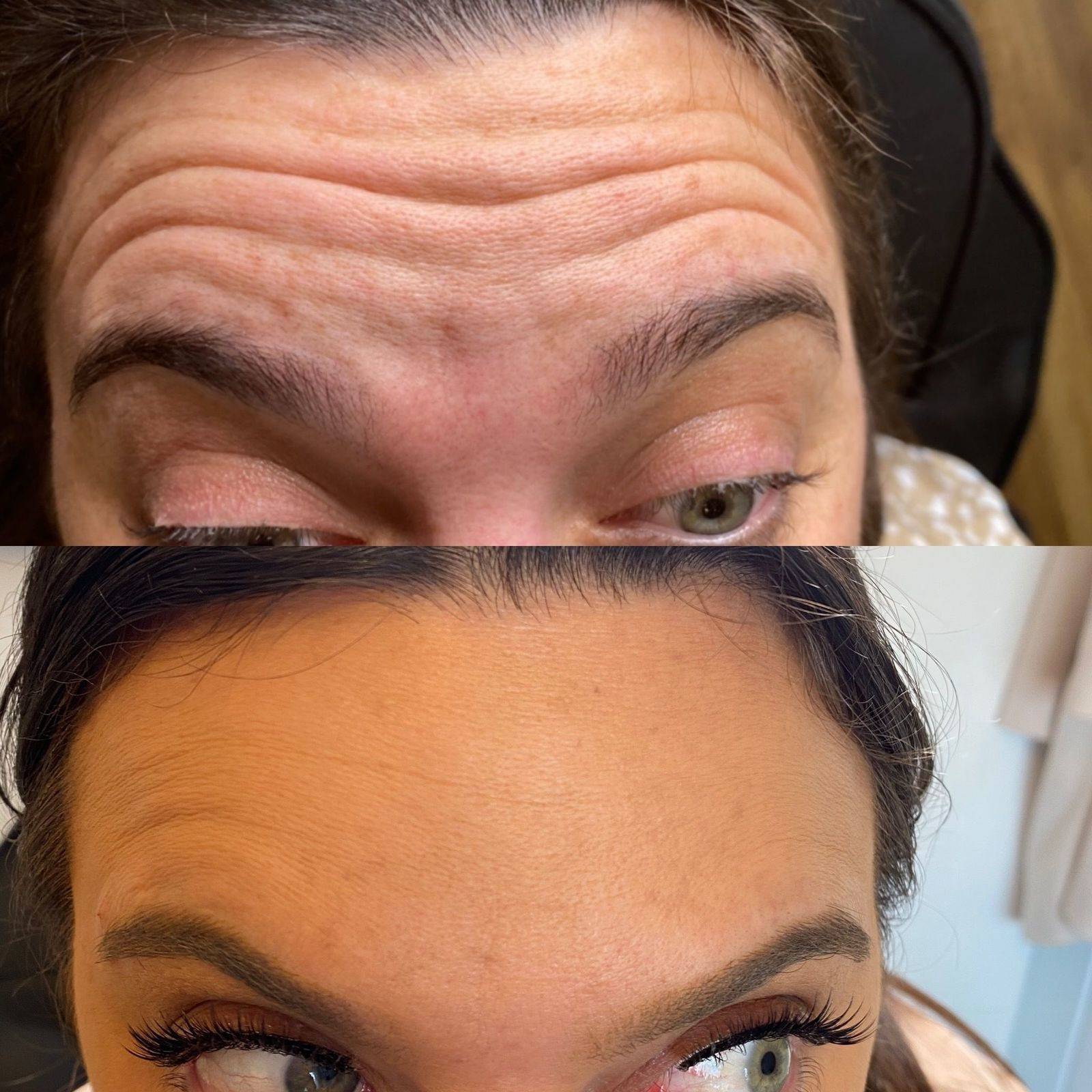 Botox Before and Afters
