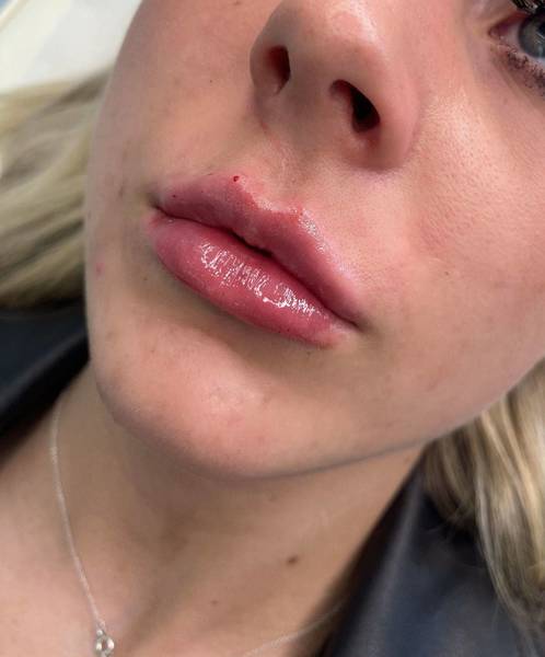 1.1ml Lip Enhancement 