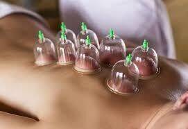Cupping Therapy 