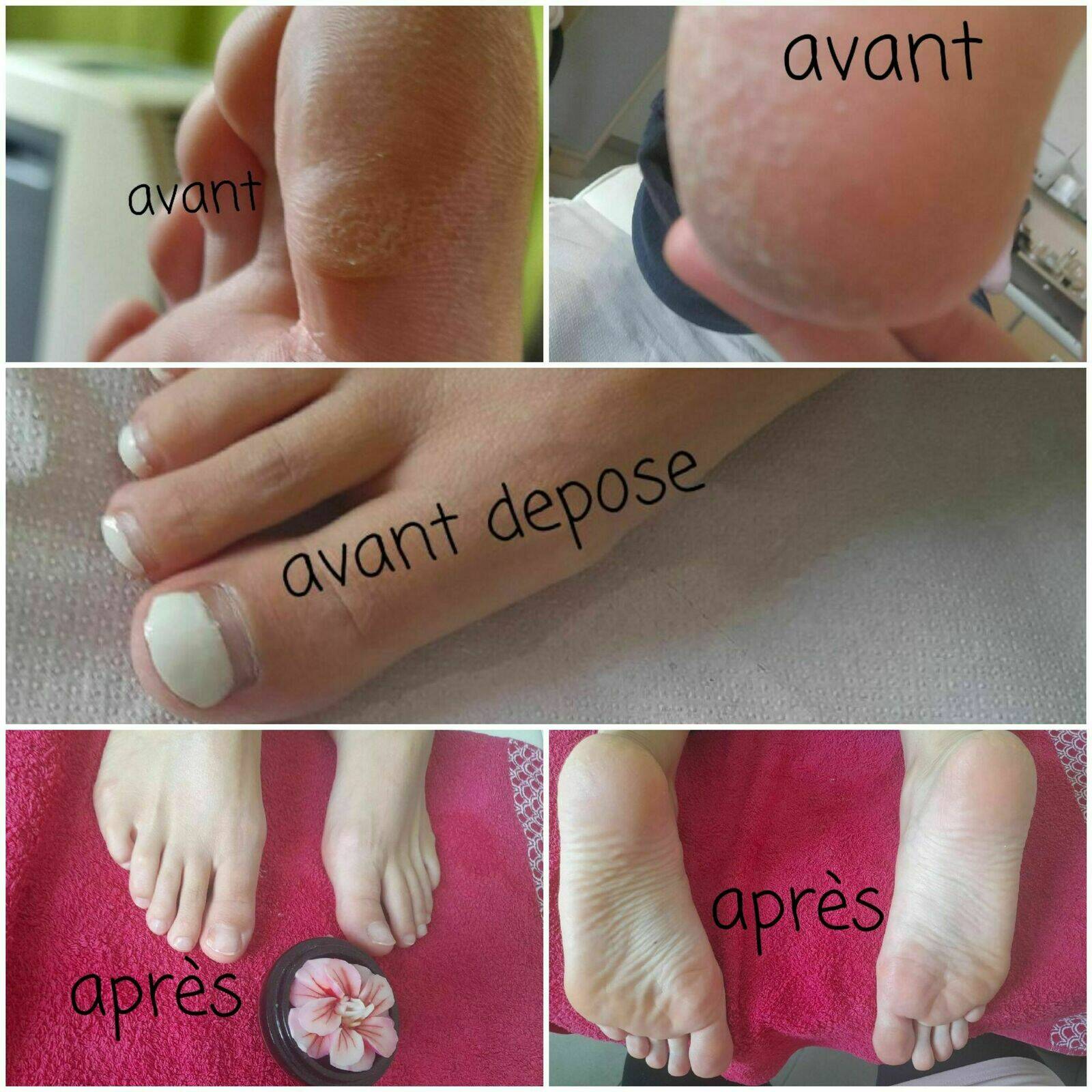 Soins pieds avec dépose 