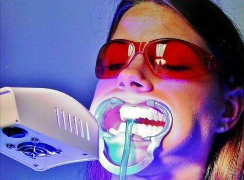 Kosmetische Zahnaufhellung 