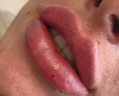 1.1ml Lip Enhancement 