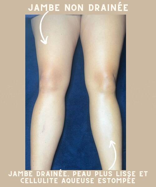 Le forfait drainage lymphatique du corps entier