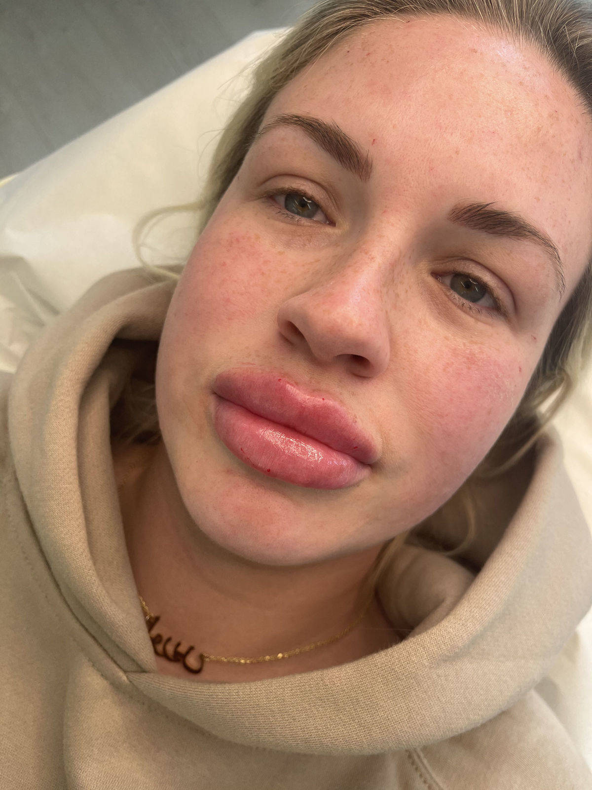 1.1ml Lip Enhancement 