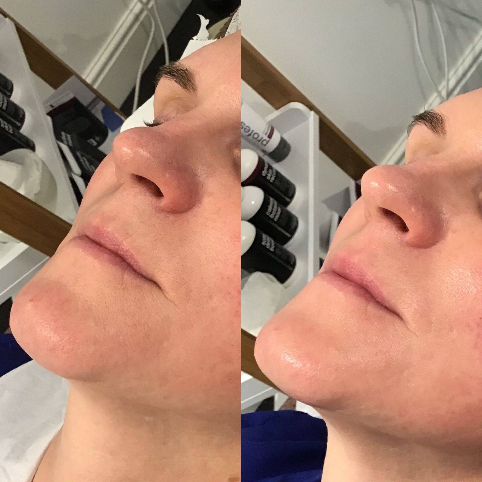 Non surgical facelift results around the mouth.