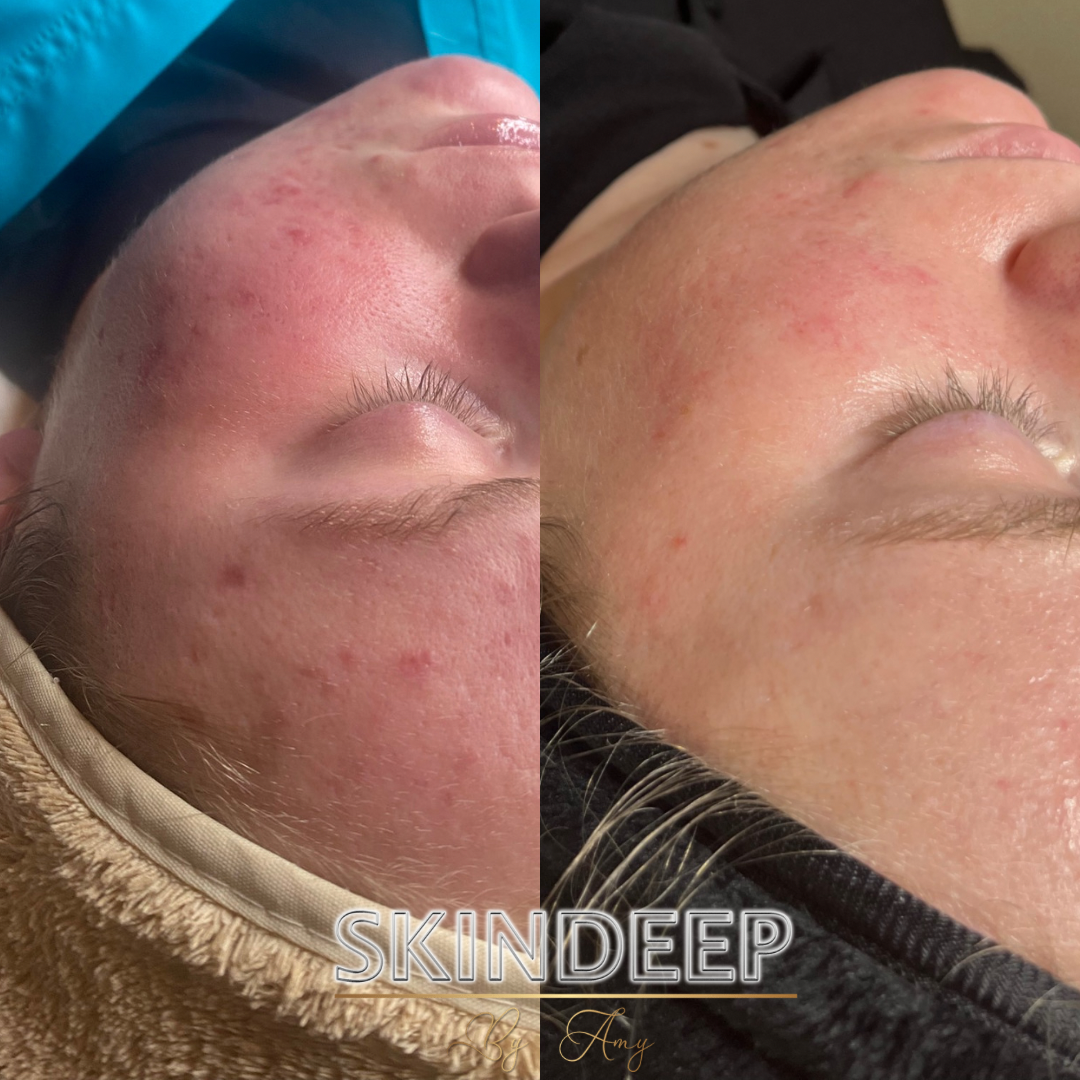 Soothing Acne prone skin with High frequency & LED light therapy