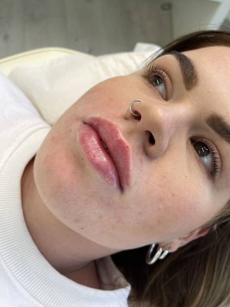 1.1ml Lip Enhancement 