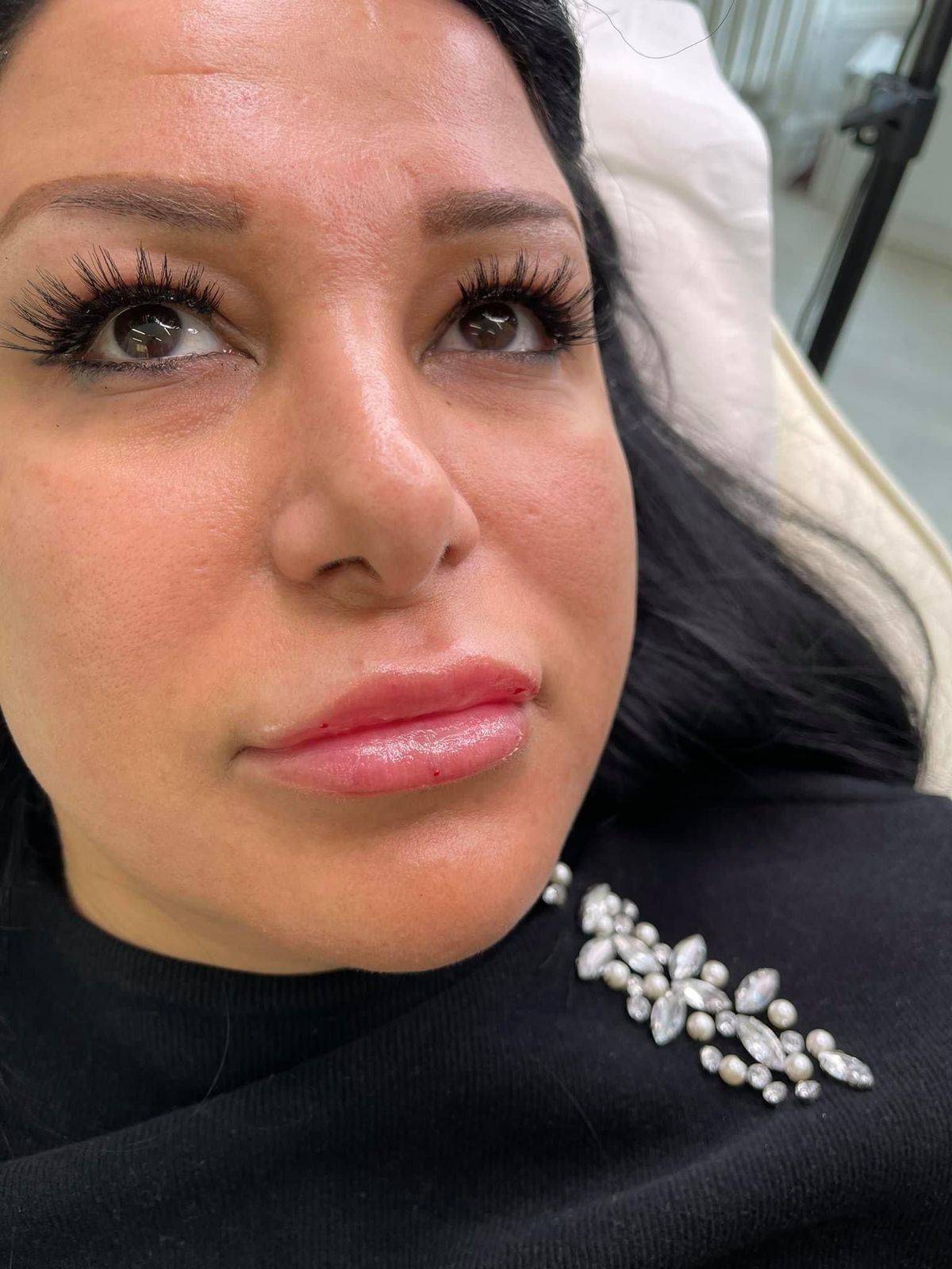 1.1ml Lip Enhancement 