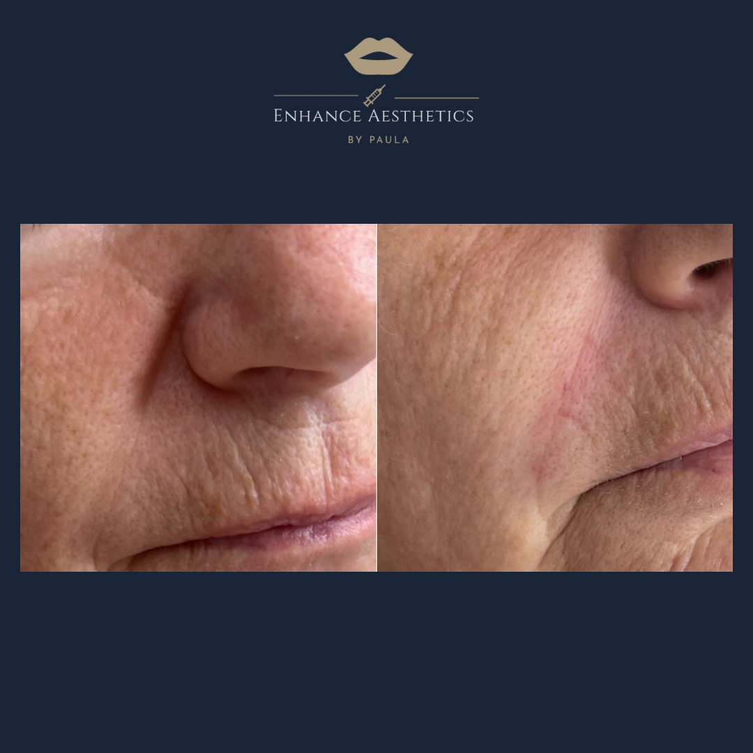 Naso Labial Treatment