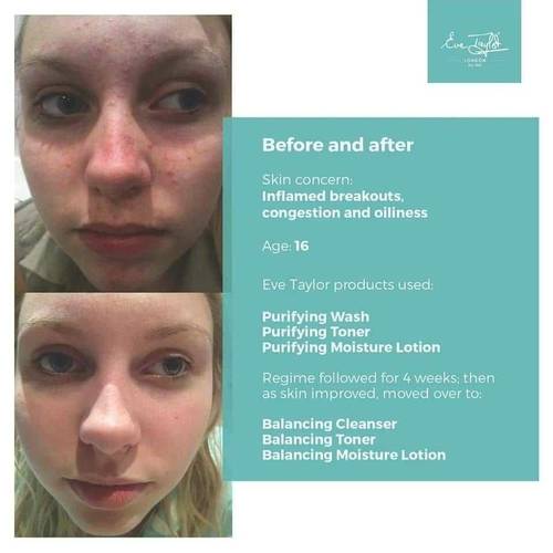 Before and After pictures from using Eve Taylor Skin care. These products work well alongside regular GalvoDerm Facials available at The Beauty Box, Duston, Northampton 