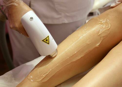 Epilation définitive