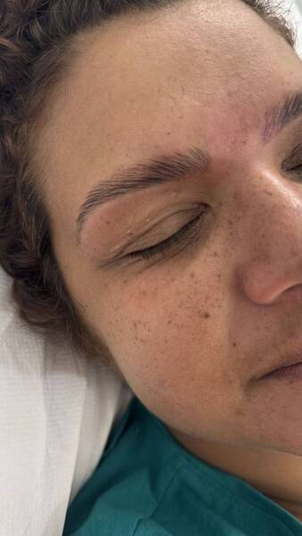 Browlift