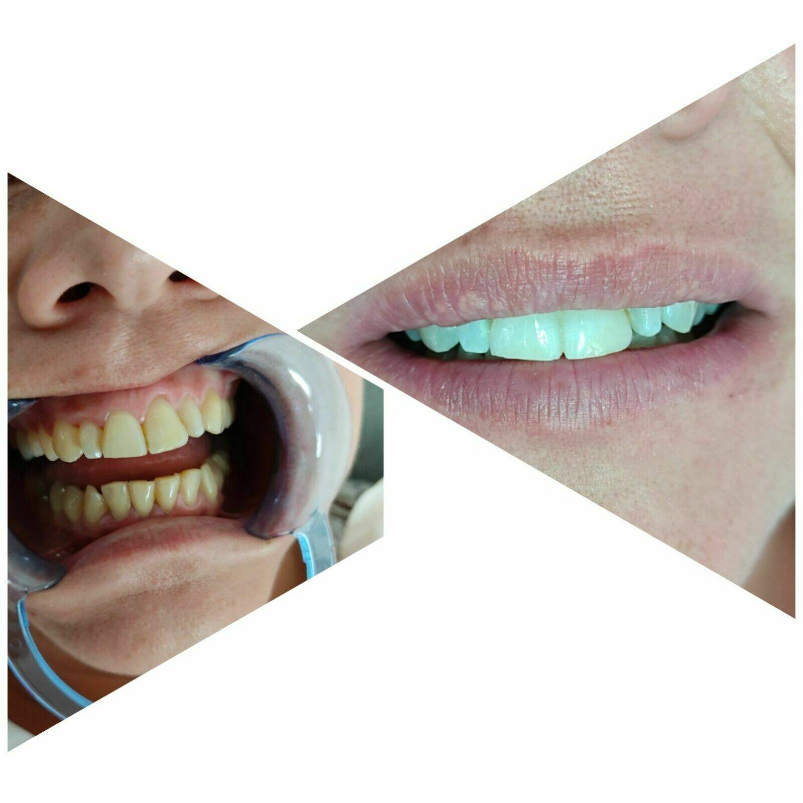 Blanchiment dentaire 