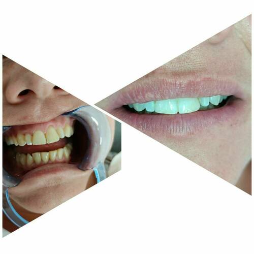 Blanchiment dentaire 