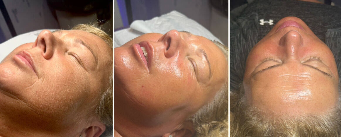 Dermaplaning & Chemical Peel