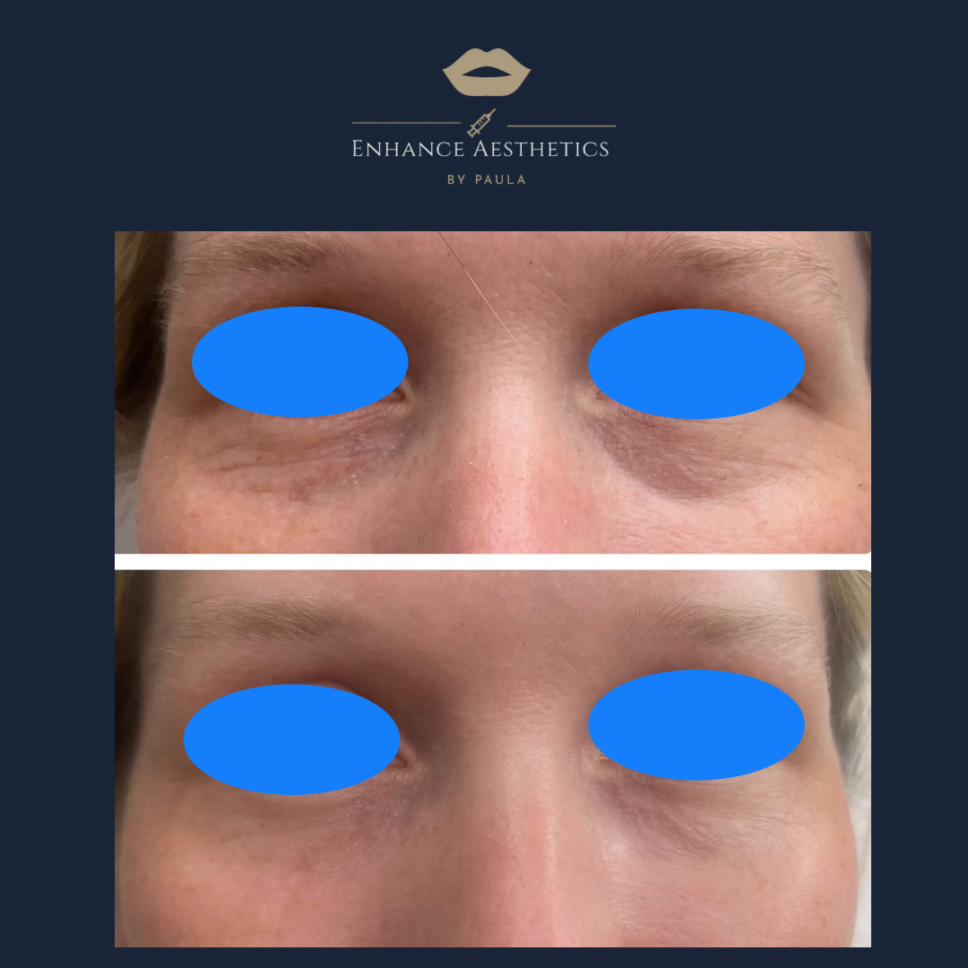 Tear Trough treatment