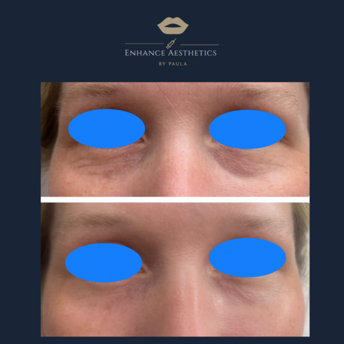 Tear Trough treatment