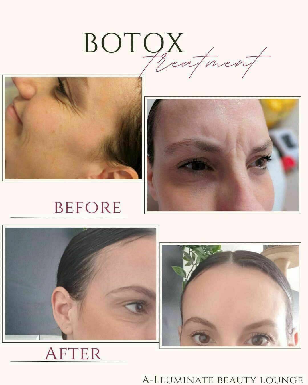 Botox 3 area