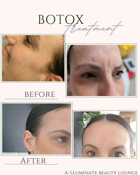 Botox 3 area