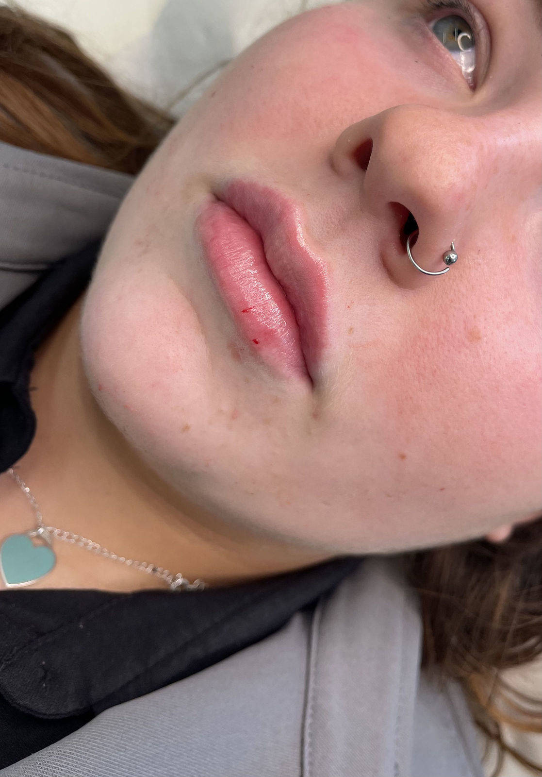 1.1ml Lip Enhancement 