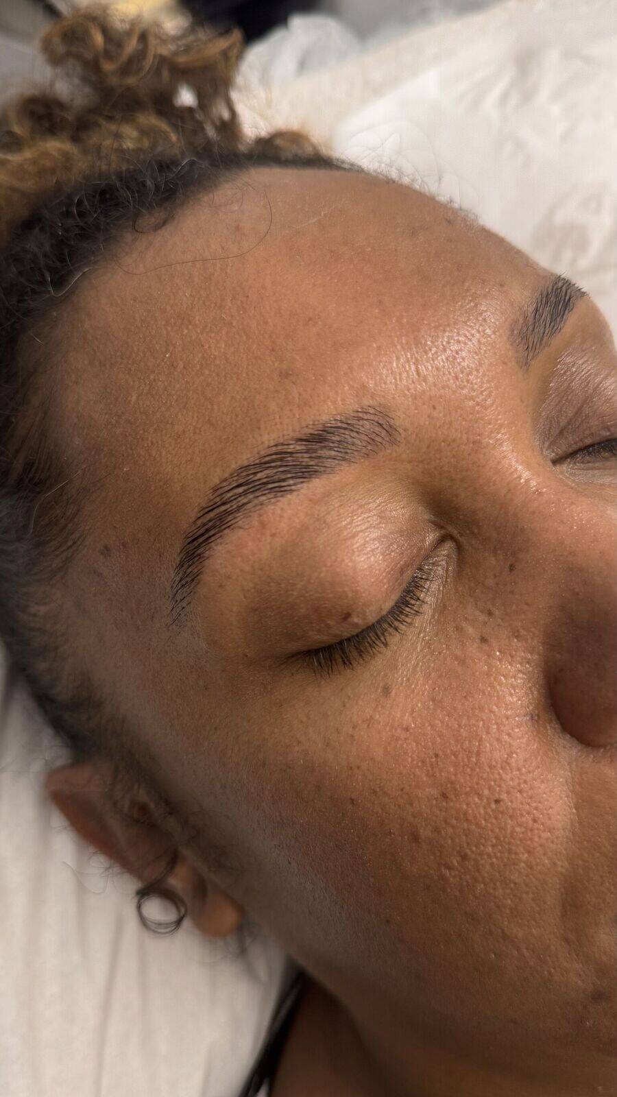 Browlift