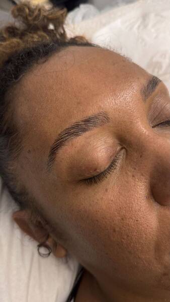 Browlift