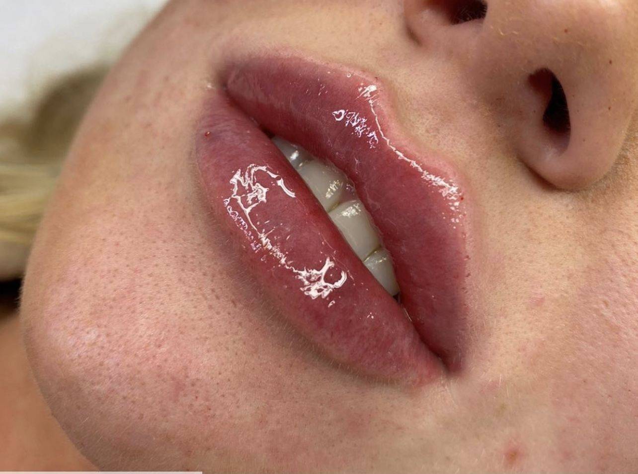 1.1ml Lip Enhancement 