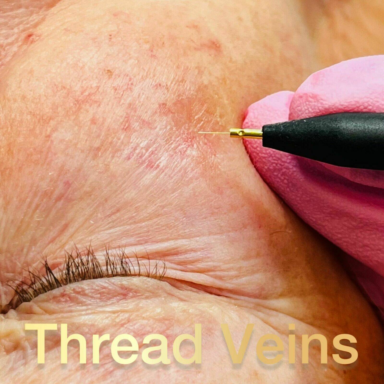 Thread Vein removal