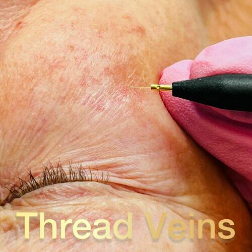 Thread Vein removal