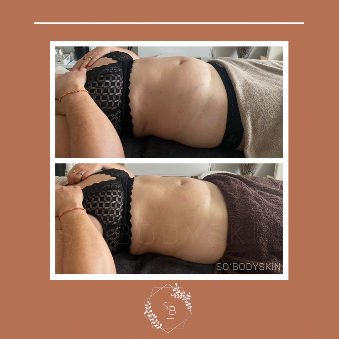 Drainage Lymphatique Brésilien - Résultat en 1 séance