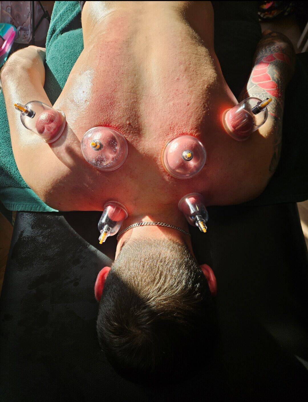 Cupping Therpay 