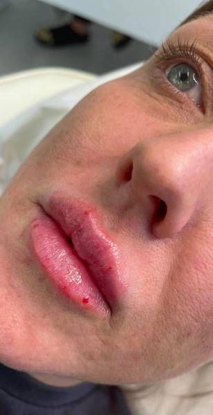 1.1ml Lip Enhancement 