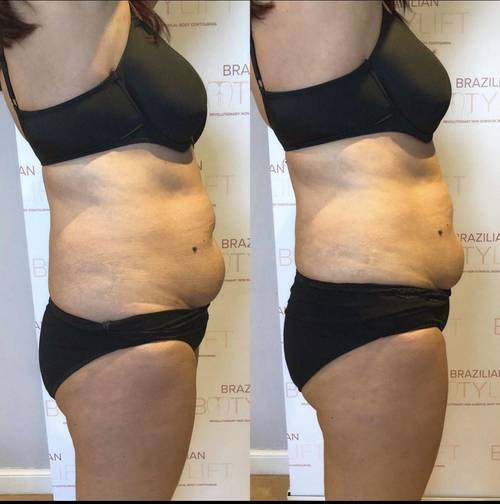 One session of Tummy Sculpt Ultimate 