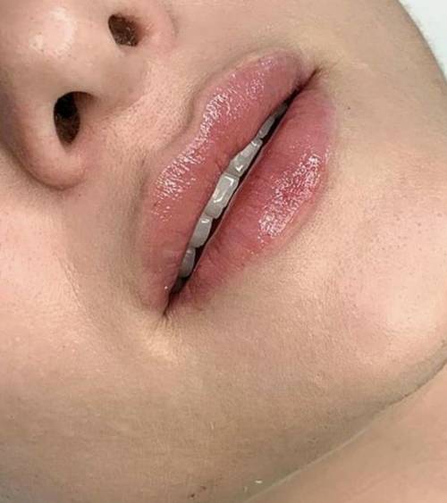 1.1ml Lip Enhancement 