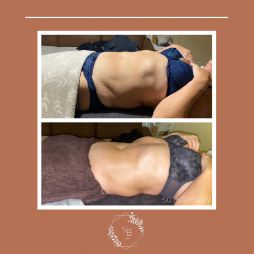 Drainage Lymphatique Brésilien - Résultat en 3 séances