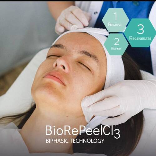 Chemical Peel 35% with minimal flaking