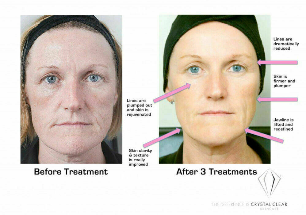 Frozen Facial