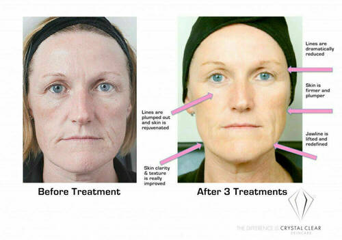 Frozen Facial