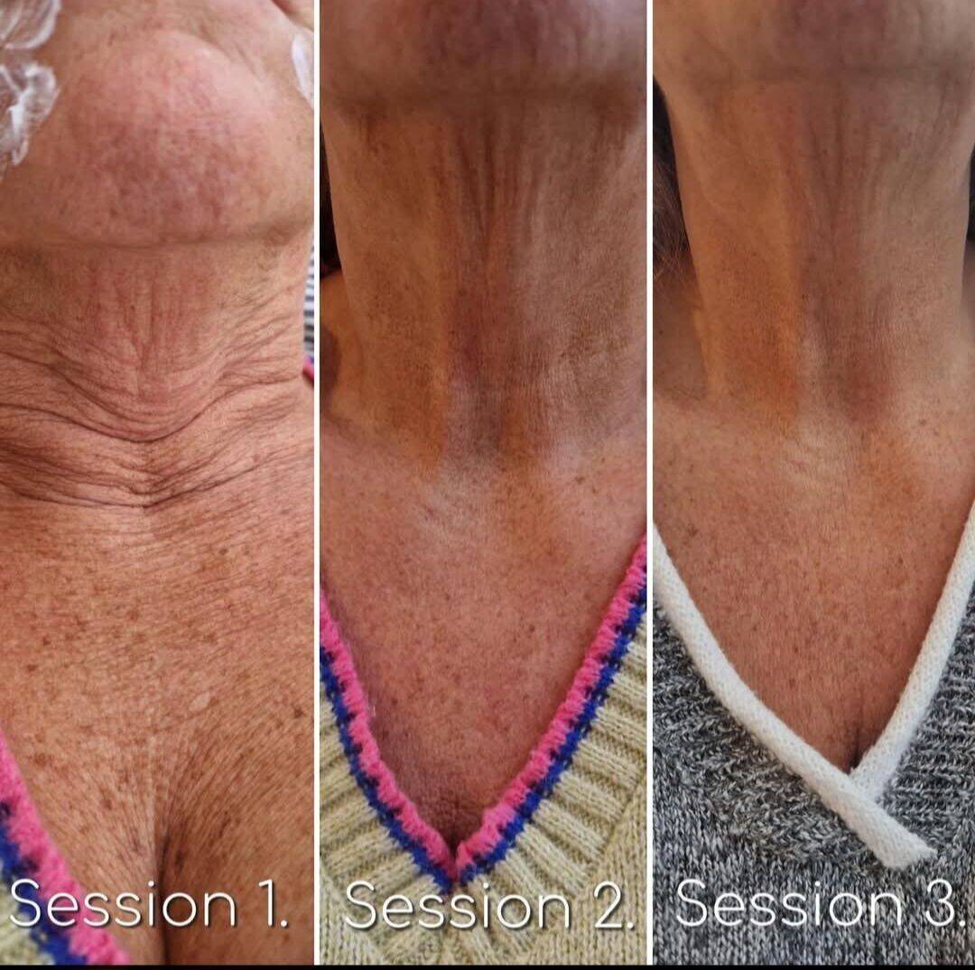 Derma tone neck (can be used in other areas also)