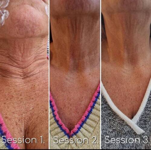 Derma tone neck (can be used in other areas also)