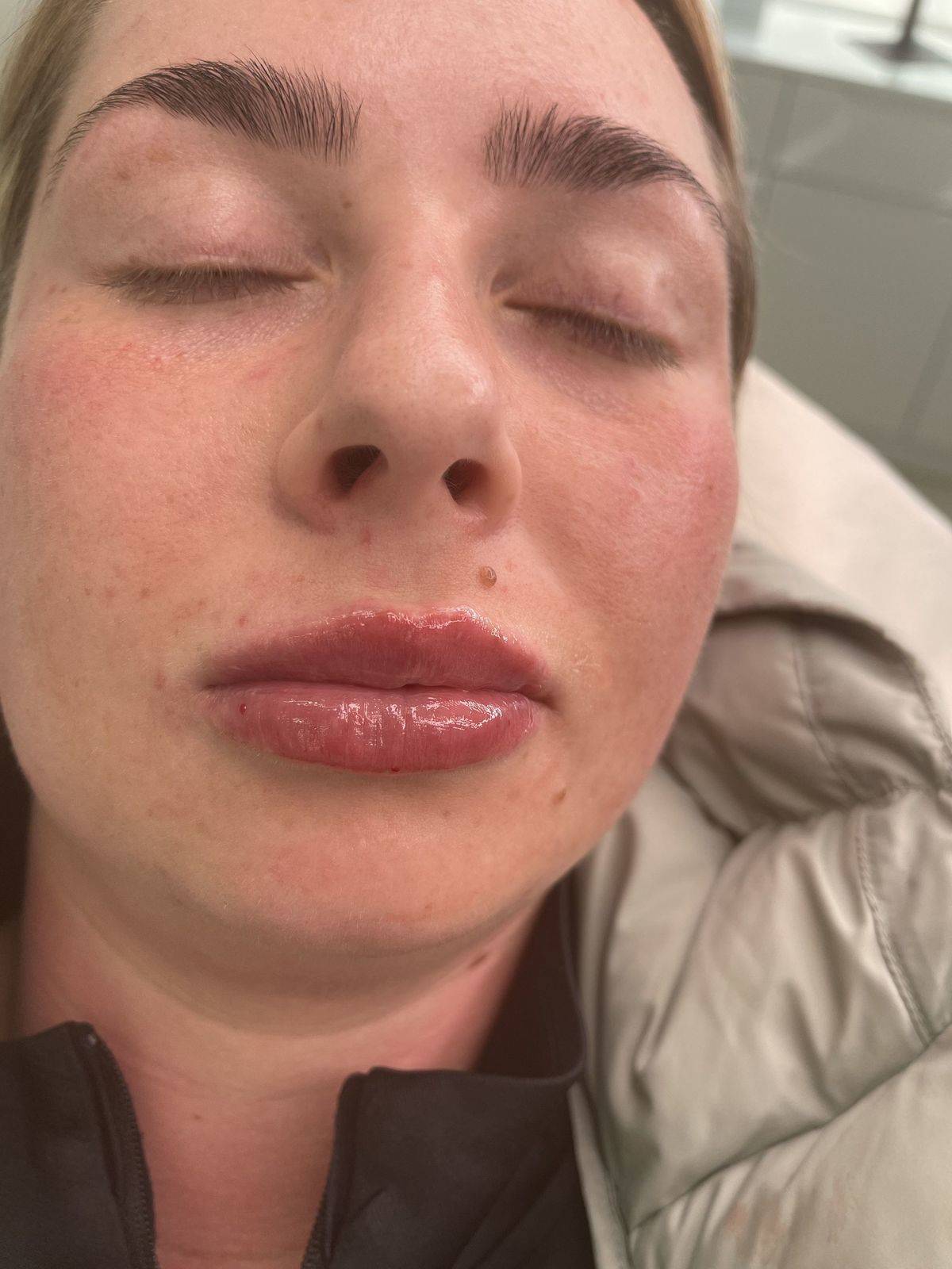 1.1ml Lip Enhancement 