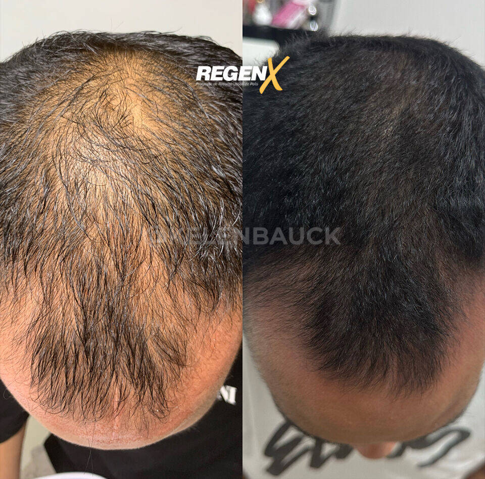 Forfait cure anti calvitie homme 10 séances