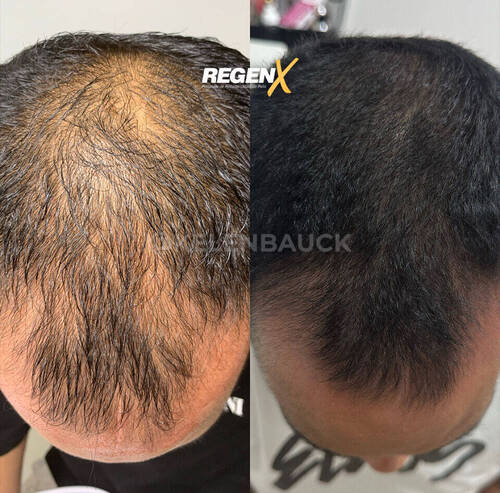 Forfait cure anti calvitie homme 10 séances