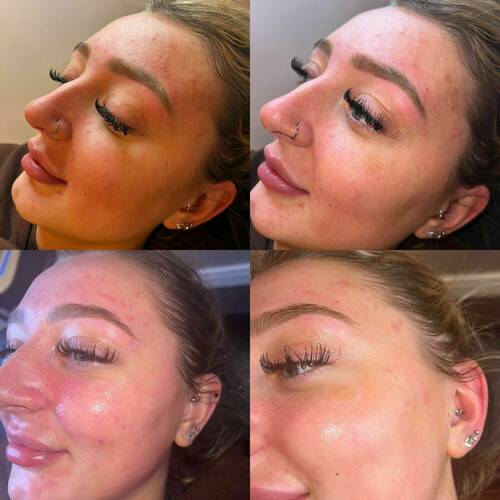 Dermaplaning Facial