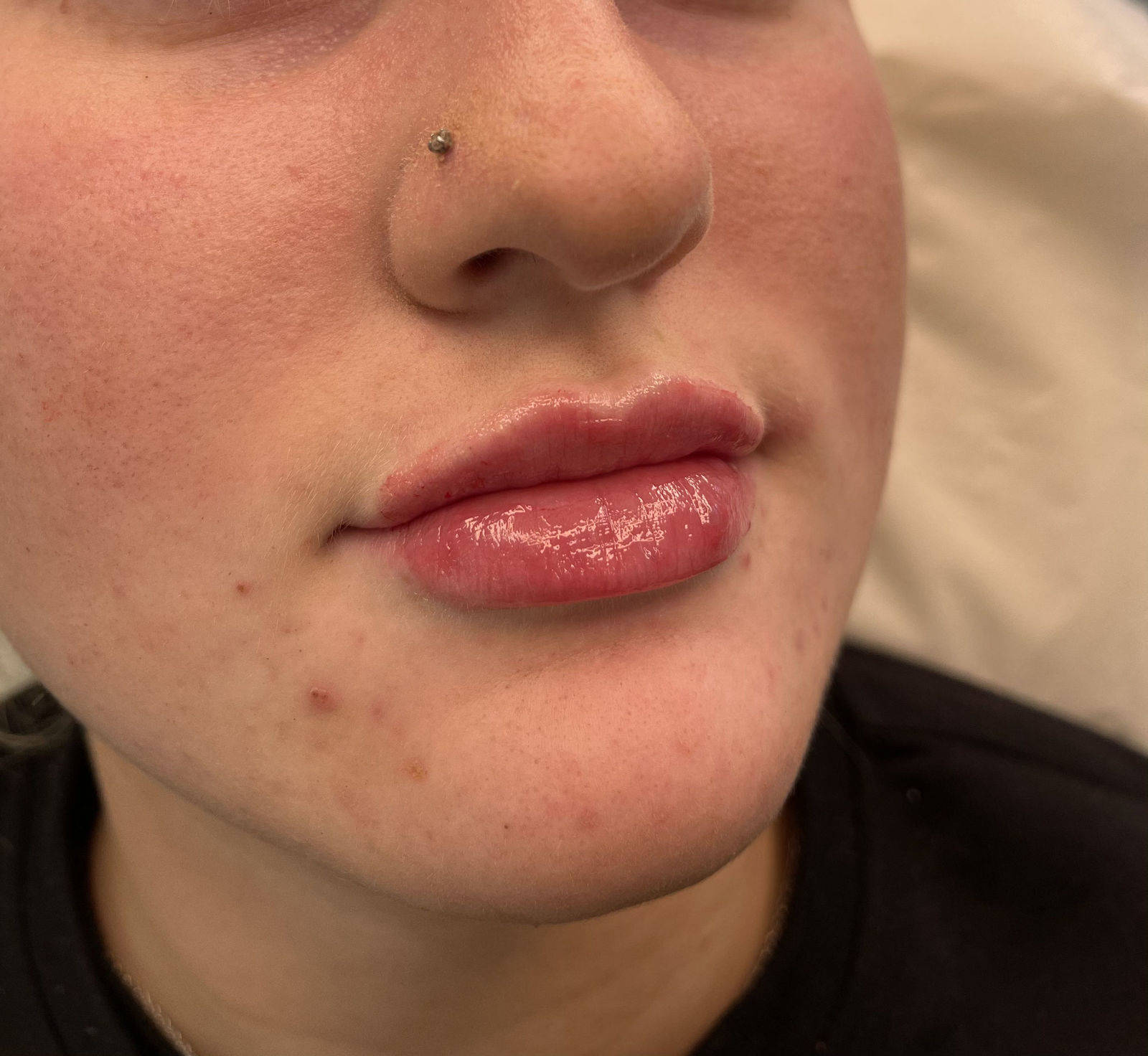 1.1ml Lip Enhancement 