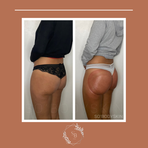 Lifting Colombien - Résultat en 5 séances