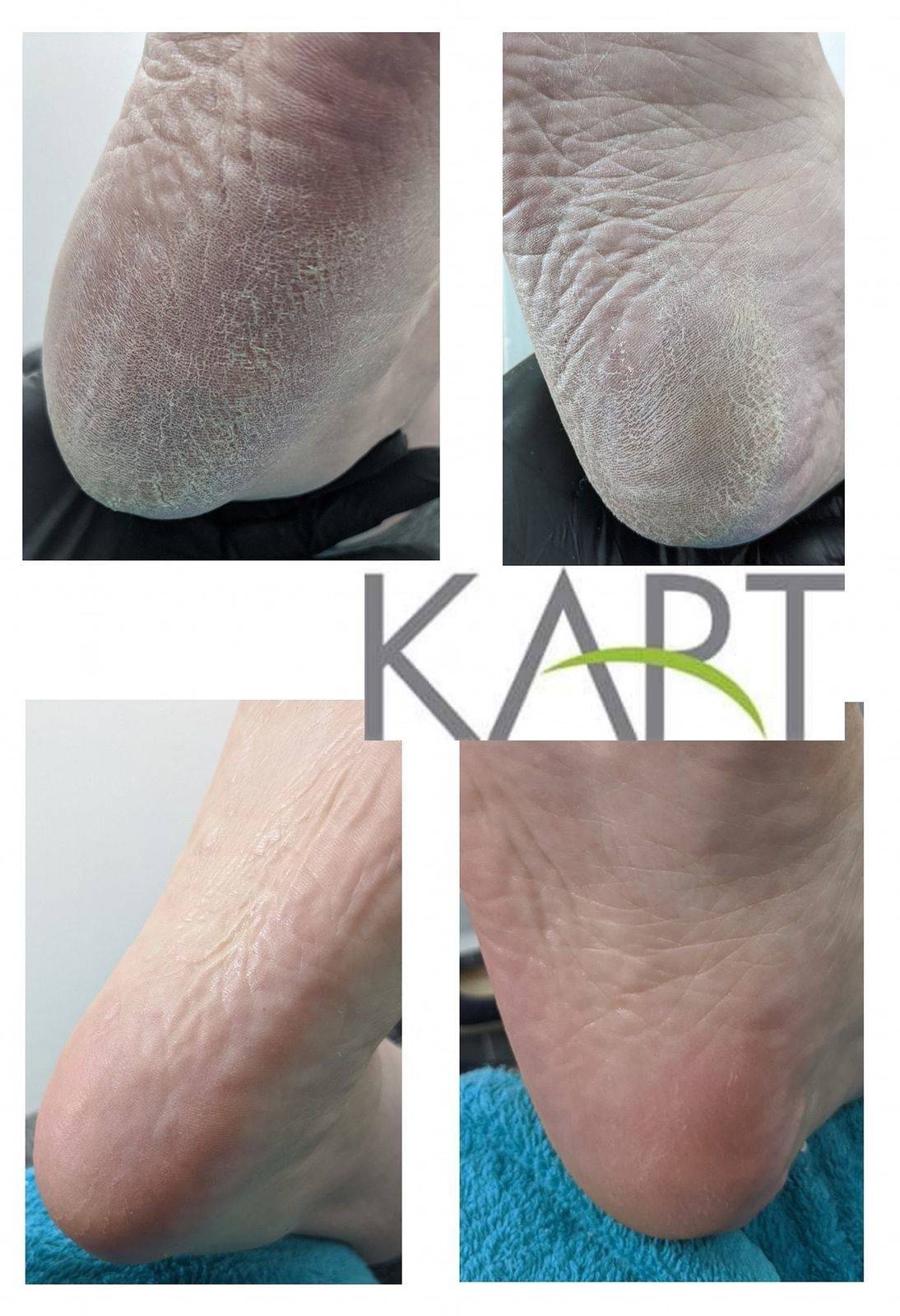 First KART treatment. Really good results