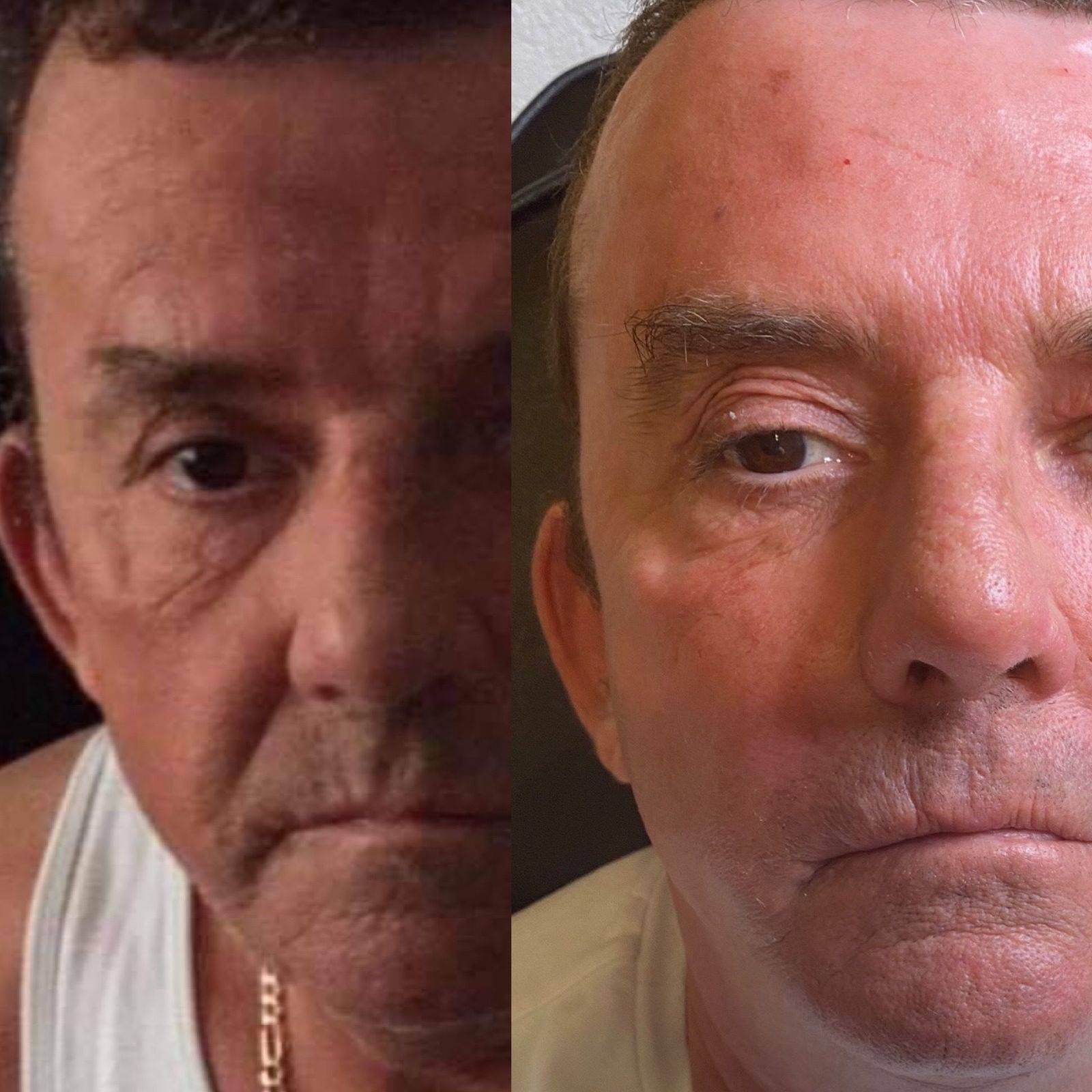 Botox Before and Afters