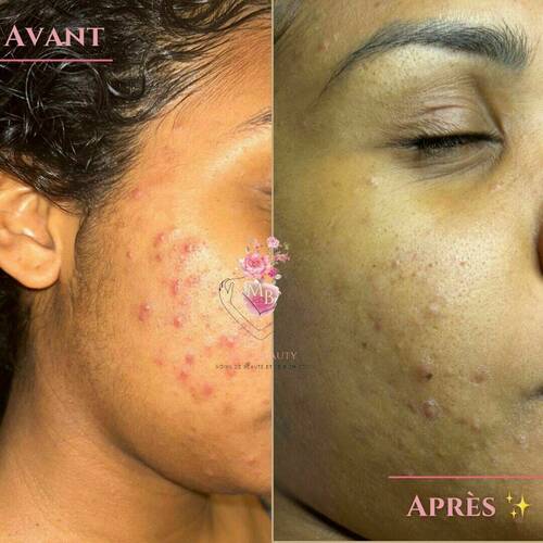 Avant/après 2 séances de soin du visage anti-imperfection