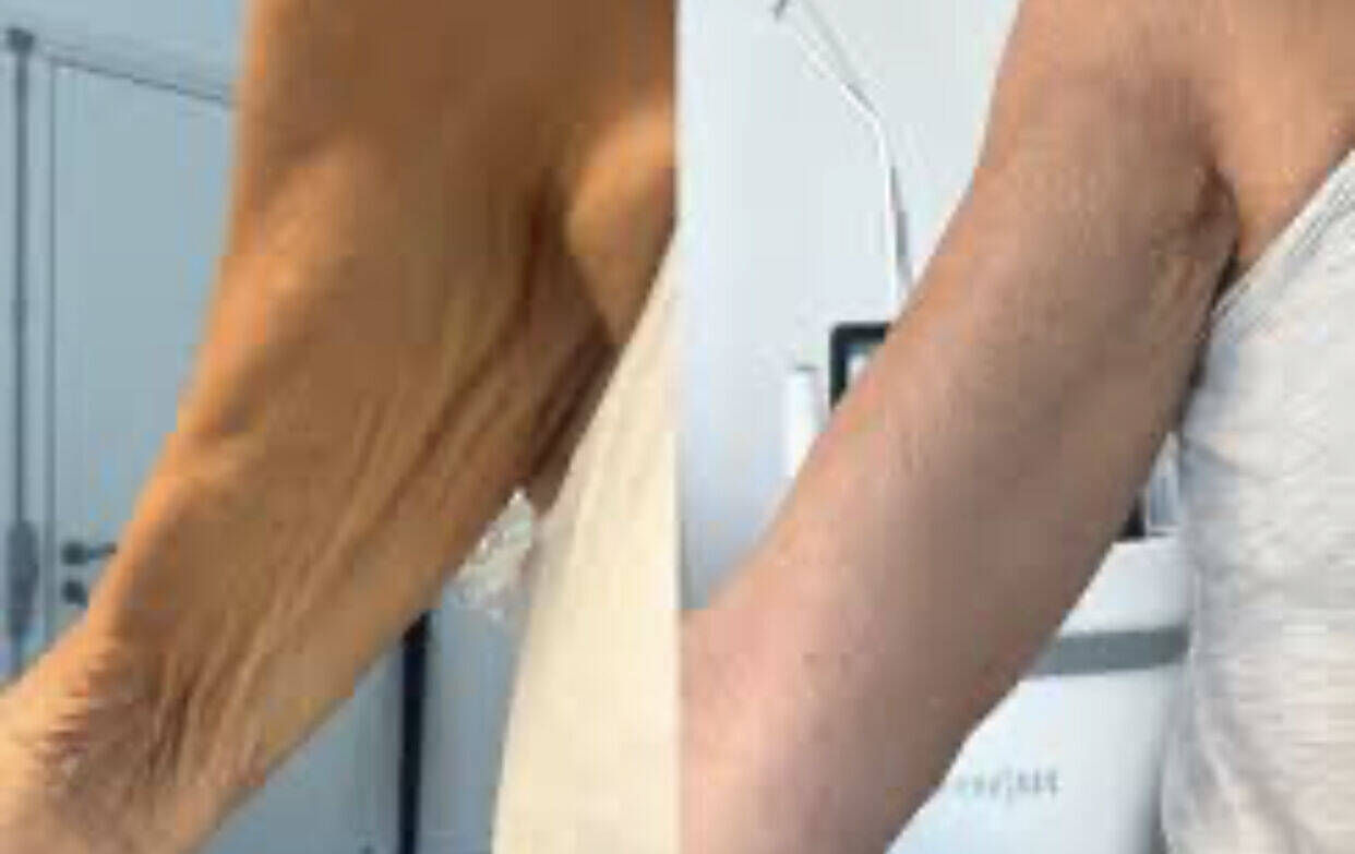 LA RADIOFREQUENCE CORPS - bras cure de 6 soins de 20 min